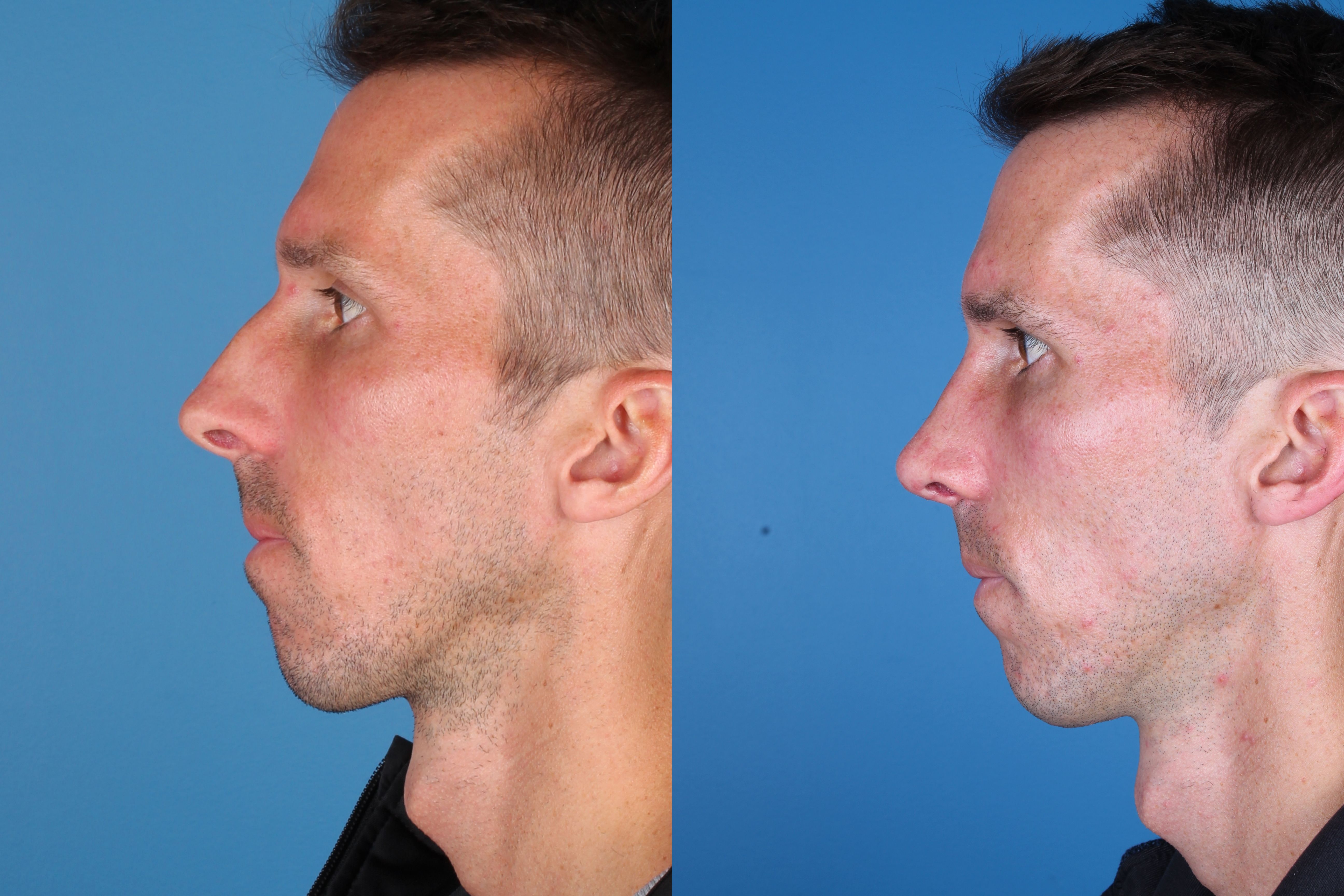 Denver Rhinoplasty Before And Afters Raval Facial Aesthetics